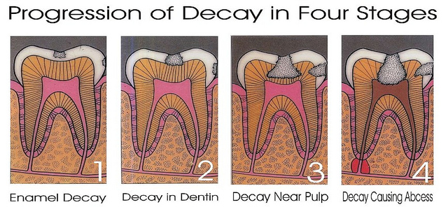 tooth decay