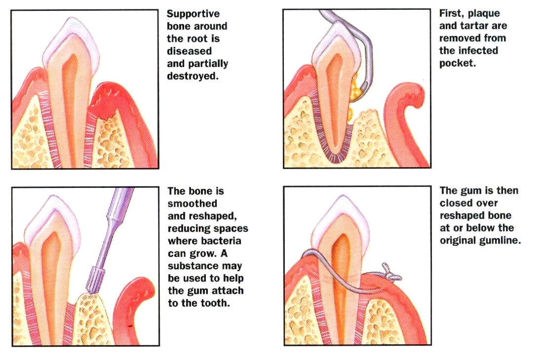 Gum Procedures