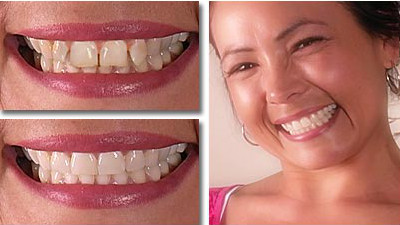 veneers