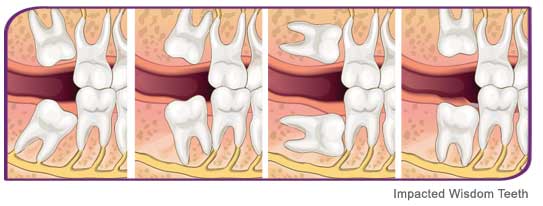 Wisdom teeth